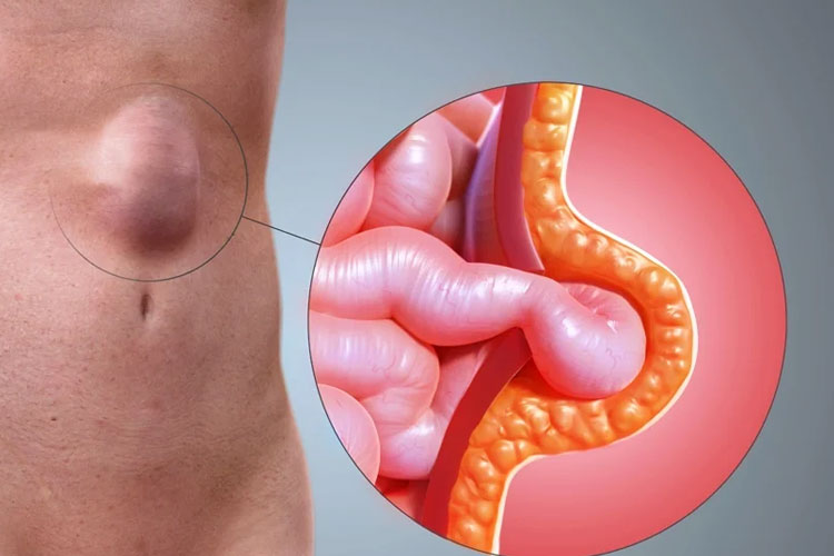 Clínica de Hernias CANADI