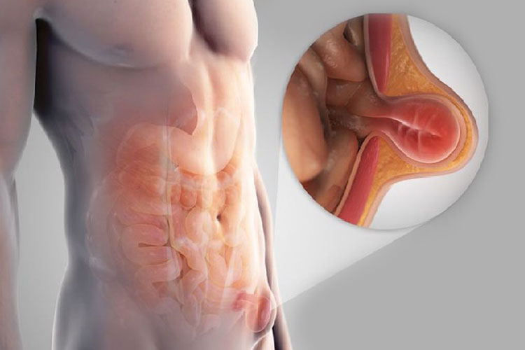Clínica de Hernias CANADI