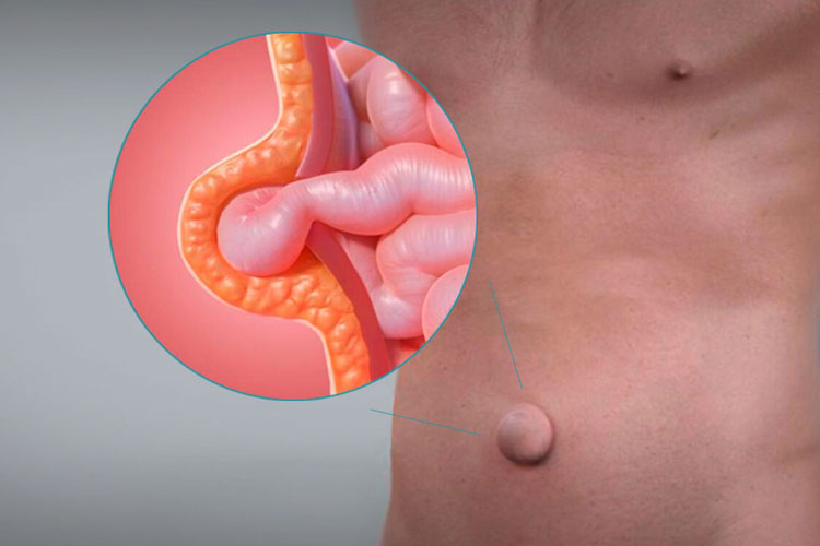 Clínica de Hernias CANADI